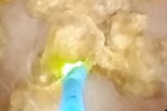 输尿管软镜钬激光碎石术治疗肾结石